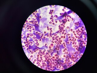 The slide shows a large number of white blood cells, appearing as round or irregularly shaped cells...