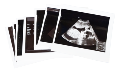 積み重なったエコー写真, 切り抜き