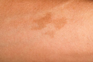 Fototapeta premium Texture of skin with birthmark as background, closeup