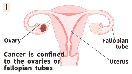 Ovarian cancer Stage 1 diagram