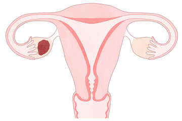 Blank Ovarian cancer Stage 1 diagram