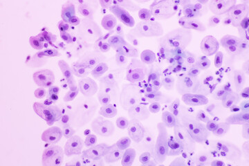 Human normal squamous epithelial cells view in microscopy.Atrophic smear criteria for pap smear slide cytology and pathology.Basal and parabasal cells on white background.