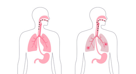 Aspiration pneumonia poster
