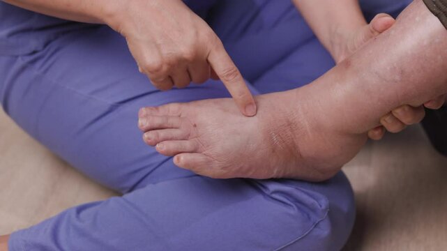 Elderly woman has edema or swelling foot.
