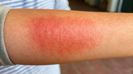 red rash appears on skin of arm, indicating possible irritation or infection. This condition may be related to scalp issues or fungal infections