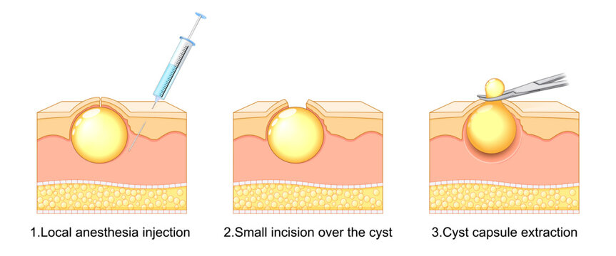 Sebaceous Cyst Removal