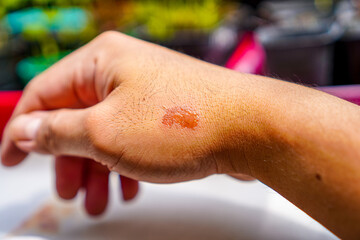 Close-up of Burn on Hand for Healthcare or Medical Purposes