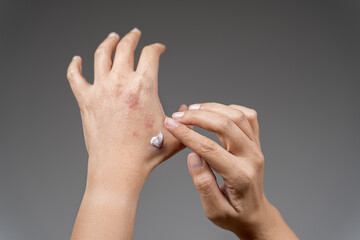 Applying cream woman's hand. Apply topical steroids, medical concept.