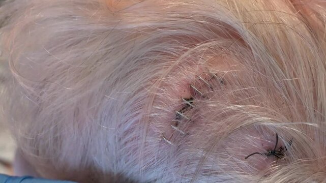 Close-up of surgical staples from a medical procedure on the head, with blue-gloved hands applying a dressing