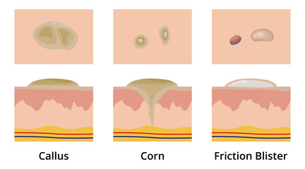 Callus, Corn and Friction Blister on Human Skin Cross Section