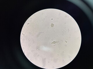 UTI urine sediment in filed.