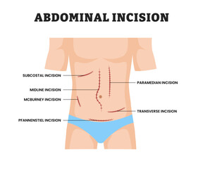 Abdominal Incision for man, educational medical poster design healthcare scheme, labeled Surgical Cut in Abdomen for Medical Procedure, Anatomy, Laparotomy, Surgery Education