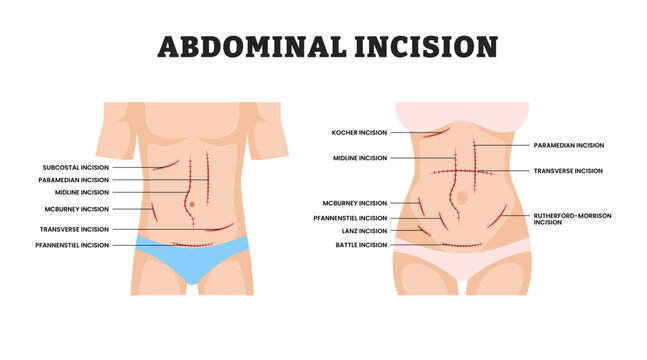 Abdominal Incision for man and woman, educational medical poster design healthcare scheme, labeled Surgical Cut in Abdomen for Medical Procedure, Anatomy, Laparotomy, Surgery Education