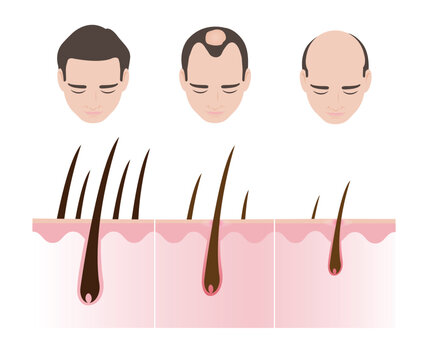 Step of male pattern hair loss vector illustration isolated on white background. The man with stages of hair losing with scalp layer anatomy. Androgenetic alopecia, male pattern baldness.
