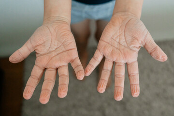 Wrinkled Hands After Immersion in Water