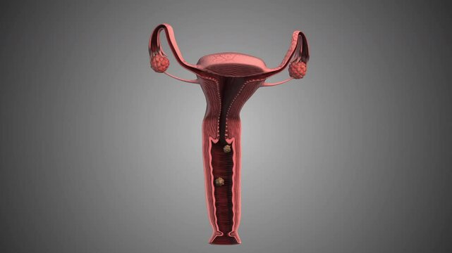 Stone Formation in Vaginal or Cervical Region