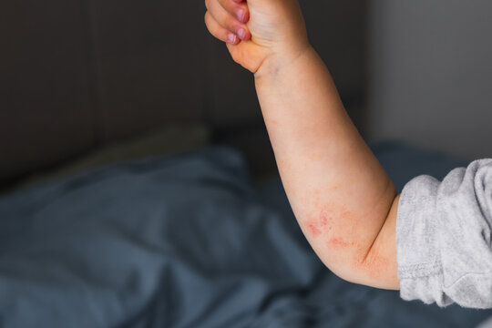 small hand of child covered by eczema. allergy baby skin dermatitis food