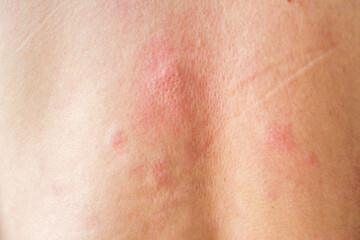 Fototapeta premium Young asian man itching and scratching on his back from allergic itchy dry skin eczema dermatitis insect bites