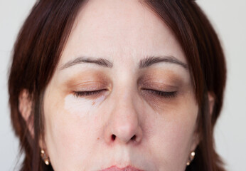 Close-up portrait of young caucasian woman's face with big pigment spots on the skin under eyes. Cosmetology. Vitiligo skin