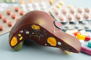 Liver model with pill drug treatment, Cirrhosis, Liver cancer, fatty liver.