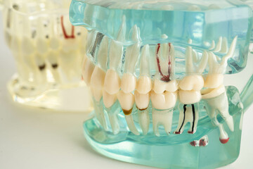 Dental implant, artificial tooth roots into jaw, root canal of dental treatment, gum disease, teeth...