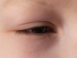 Painful red eye of a girl during a viral cold. Inflammation conjunctivitis, macro