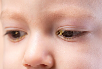 Fototapeta premium Pus in a little boy's eyes. Concept of bacterial and viral conjunctivitis in children, close-up