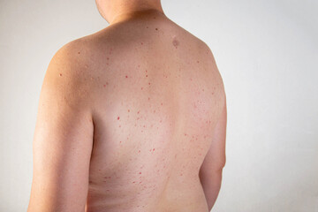 Naklejka premium Red pimples on a man's back. Concept of inflammation of the sebaceous glands, dermatology, close-up