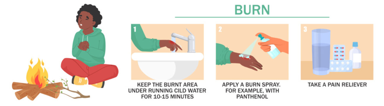 Instructions for treating burns include running cold water on the area, applying burn spray with pantheon, and taking a pain reliever to ease discomfort and promote healing.