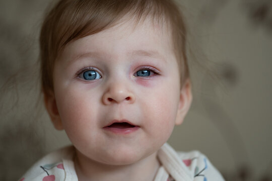 Close up of baby with bacterial purulence conjunctivitis, also known as pink eye. Eye infection.