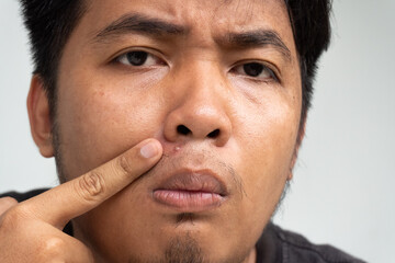 A young man is bothered by a large pimple on his face.