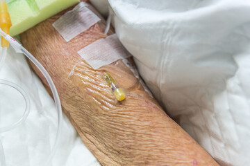 Patient with saline intravenous in the hospital