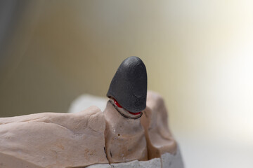 Frames of ceramic-metal  crowns on the stand of the articulator