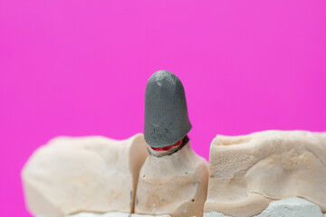 Frames of ceramic-metal  crowns on the stand of the articulator