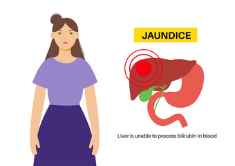 Jaundice yellow skin