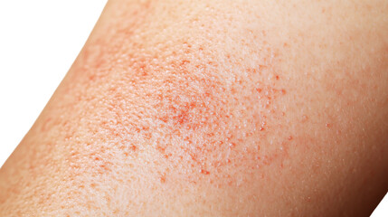 Fototapeta premium Skin Irritation: A close-up view revealing the intricate details of irritated skin, marked by redness, subtle texture variations, and a raw appearance.