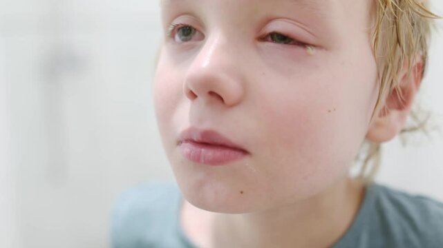Sick boy with pus on his eyelid and red broken blood vessels in eye. Conjunctivitis, trauma of eye, inflammation, infection, allergy or intraocular pressure are reason for contacting ophthalmologist.