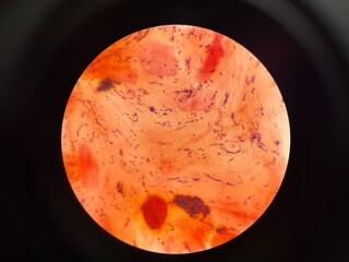 Mixed organism bacteria in sputum gram stain.
