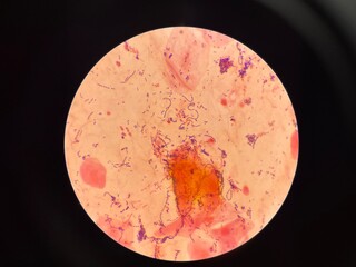 Mixed organism bacteria in sputum gram stain.