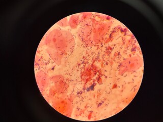 Mixed organism bacteria in sputum gram stain.