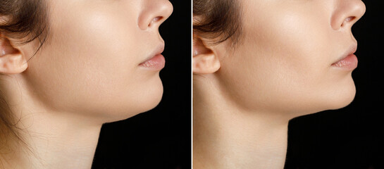 Female double chin before and after correction. Correction of the chin shape liposuction of the...