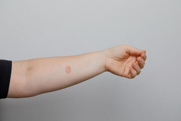 Hand with rash. Red psoriatic eruptions or inflamed eczema. Allergic urticaria problems and infectious