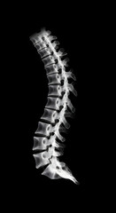 Twisted Spine X-ray with Scoliosis Symptoms