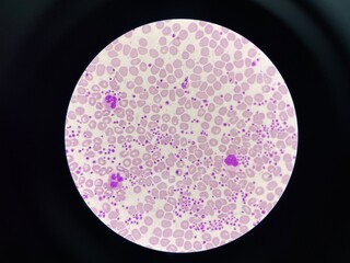 This image shows a blood smear under a microscope, revealing an abnormally high number of platelets. The platelets appear as small, irregularly shaped cell fragments scattered throughout the field. 