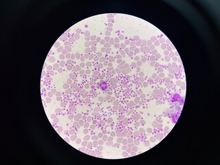 This image shows a blood smear under a microscope, revealing an abnormally high number of...