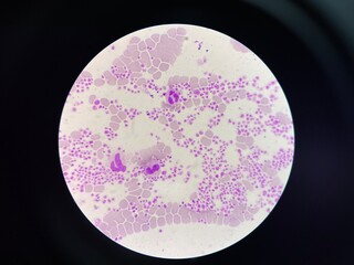 This image shows a blood smear under a microscope, revealing an abnormally high number of...