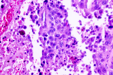 Backgrounds of human cells tissue of lung human under the microscope in pathology lab.View in microscopic of squamous cell carcinoma from human cervical cancer, tissue section by H and E