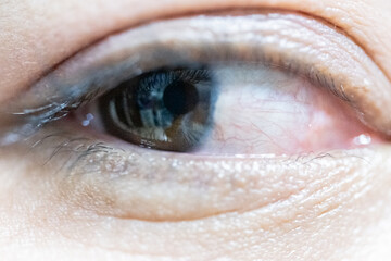 Close up of the pterygium during eye examination for treatment to ophthalmologist..Red eye symptom...