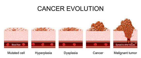 Cancer evolution from Hyperplasia and Mutated cell to Dysplasia, Cancer and Malignant tumor