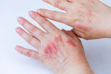 atopic dermatitis. red, itchy, womans hands. Cracked skin and allergic wounds on hands. Medical...